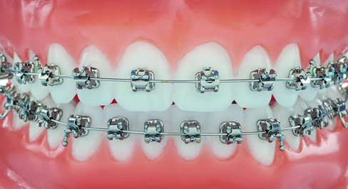 Фиксация металлической самолигирующей брекет-системы ( 1 челюсть)